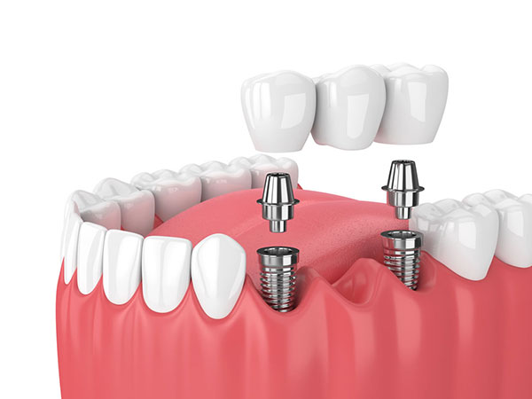 Dental Implant Supported Bridge